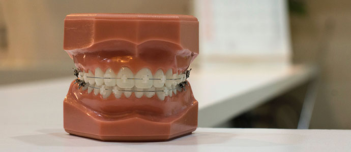 Braces on a sculpture of teeth